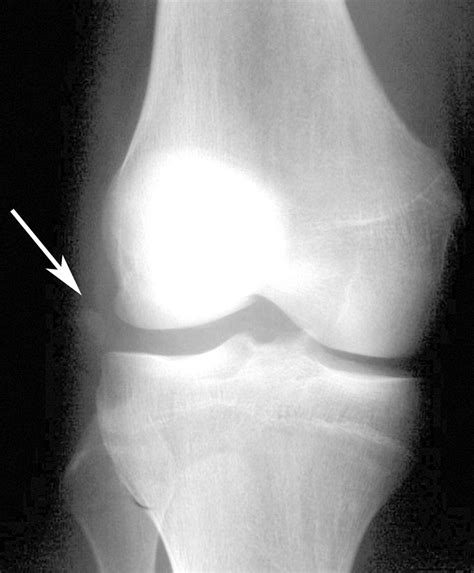 Avulsion Fractures Of The Knee Imaging Findings And Clinical