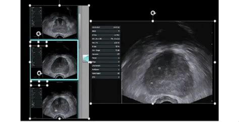 Transrectal Ultrasound Everything You Need To Know Healthtian