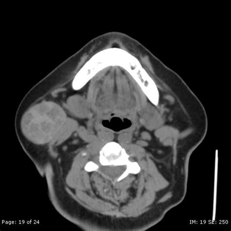 An X Ray Shows The Area In Which There Is No Image To Describe And It