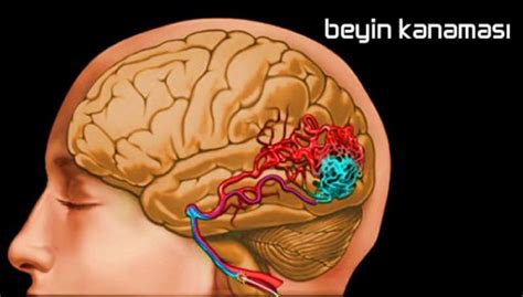 Beyin Kanaması Prof Dr Alper Kaya