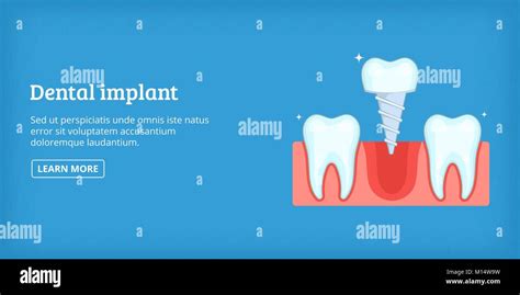 Implante Dental Banner Horizontal Estilo De Dibujos Animados Imagen Vector De Stock Alamy