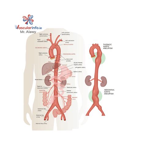 Complex Endovascular Repair Of Aortic Aneurysms