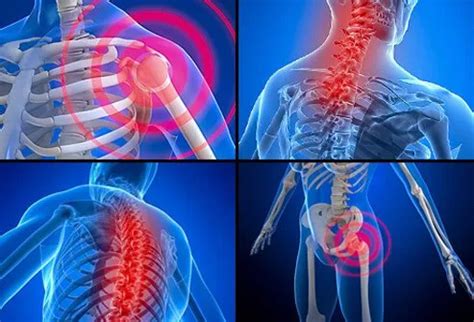 Savella (milnacipran) Side Effects, Uses & Dosing