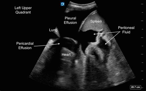 Ascites Vs Pleural Effusion Ultrasound