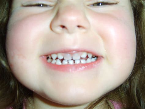 The Muminator: Grey teeth after hitting mouth