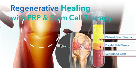 Prp And Prolotherapy