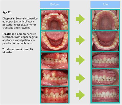 Smile Gallery Saxe Orthodontics