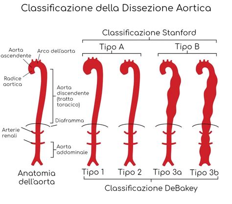 Dissezione Aortica Cause Sintomi E Cura Valori Normali