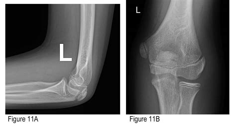 Normal Elbow X Ray In Children