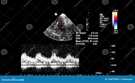 Pulse Wave Doppler Ultrasound Examination. Stock Image - Image of ...