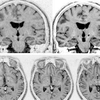 MRI of a bilateral subthalamic lesion in one representative patient ...