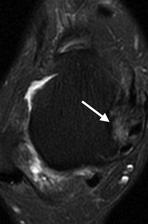 MR Imaging Of Deltoid Ligament Pathologic Findings And Associated