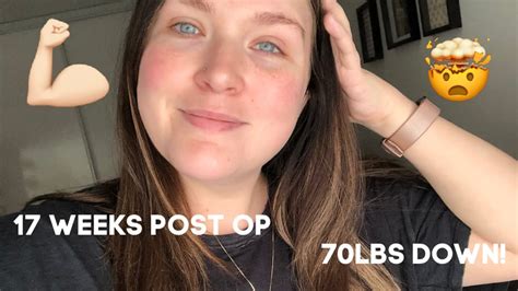 17 WEEKS POST OP VSG 70LBS DOWN YouTube