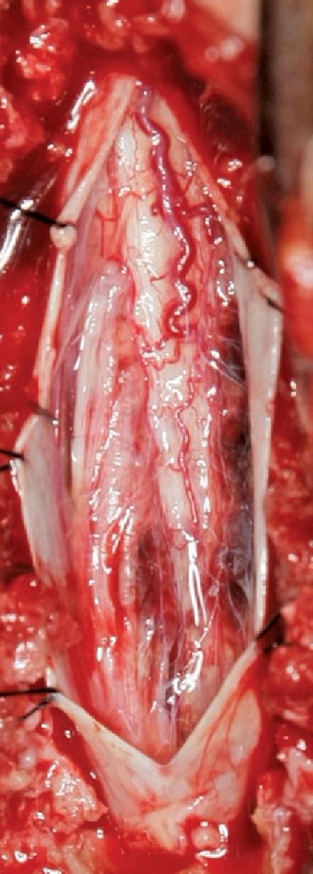 Table 1 From Intramedullary Spinal Cord Hemorrhage Hematomyelia