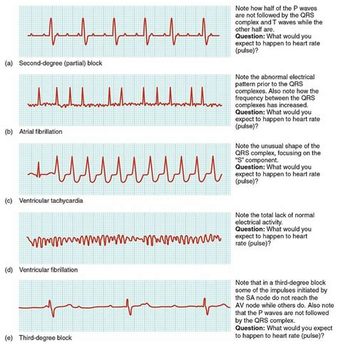 Heart Arrhythmias Physiopedia