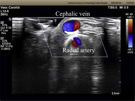 A Modified No Touch Technique For Anastomosis To Create A Radiocephalic