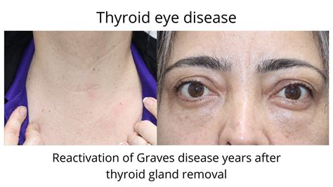 Hyperthyroidism Eyes Before And After