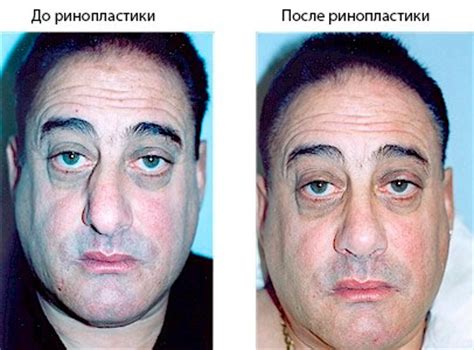 Исправить нос поможет ринопластика