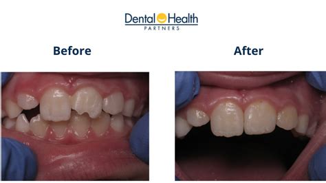 Composite Bonding | Before and After Tooth Restoration - Dental Health ...