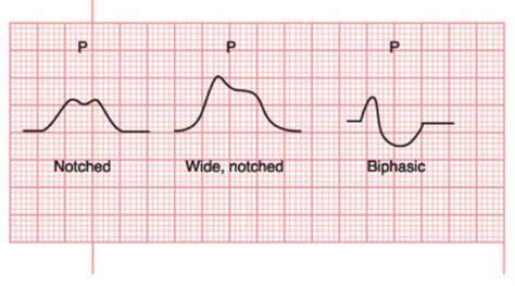 Ecg Flashcards Quizlet