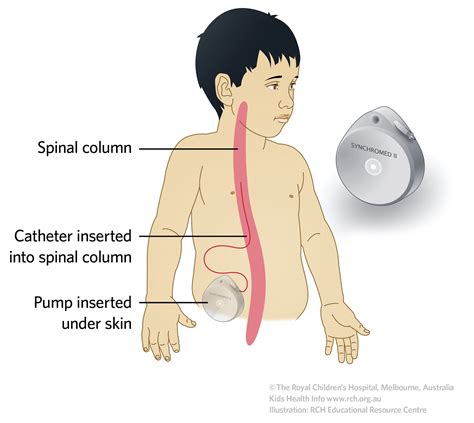 MS won't win: Baclofen Pump