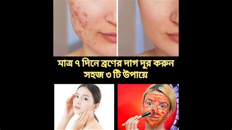 ৭ দিনে ব্রণের দাগ দূর করুন ৩ টি সহজ উপায়ে । How To Remove Acne Scars