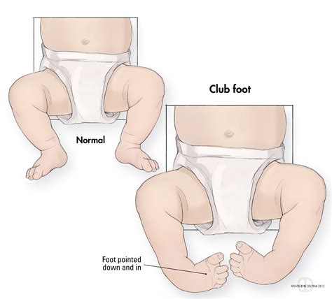 Clubfoot Treatment in Kolkata, India | Kids Orthopedic