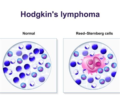 Linfoma Di Hodgkin Cause Sintomi Diagnosi E Terapie