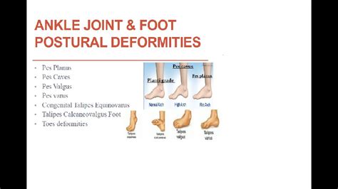 Ankle And Foot Deformities Youtube