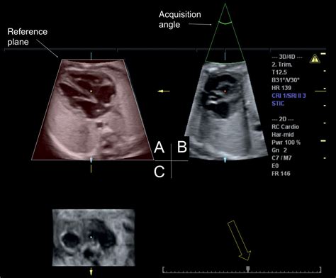 Three And Four Dimensional Ultrasound Of The Fetal Heart Obgyn Key