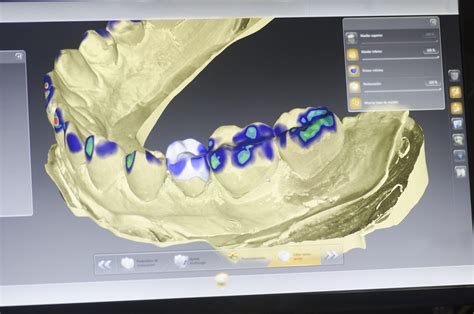 What Is A Digital Dental Implant Rowlett Tx