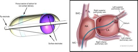 Intrapulmonary Vein Ablation Without Stenosis A Novel BalloonBased