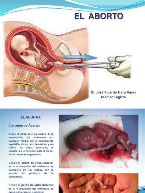 Clase Aborto Descargar Gratis Pdf Aborto Aborto Espontáneo