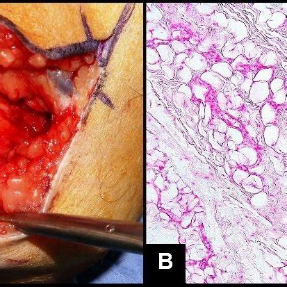 A Macroscopic Intraoperative Photography Showing Ulnar Nerve