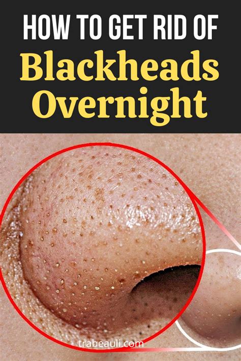 13 proven ways to get rid of blackheads and prevention tips – Artofit