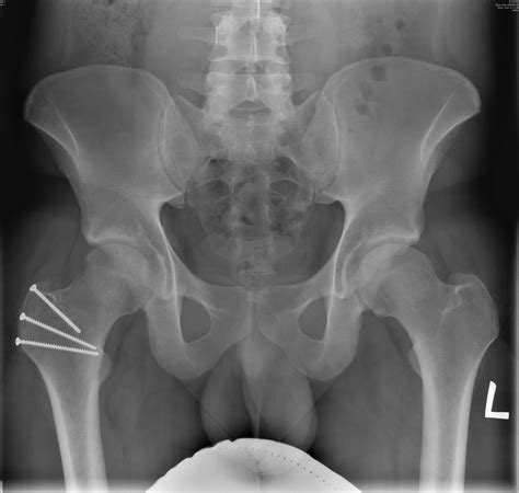 Open Surgical Dislocation Hip | Orthowood