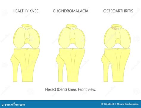 Healthy Knee Chondromalacia And Patellofemoral Osteoarthritis Stock