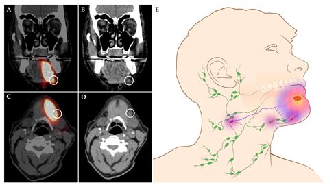 Floor Of Mouth Cancer Staging Radiology | Viewfloor.co