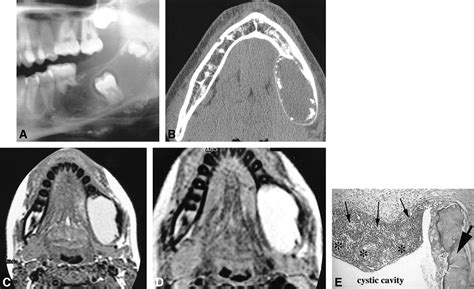 Combined Benign Odontogenic Tumors Ct And Mr Findings And Histomorphologic Evaluation