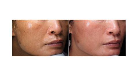 Rimuovere Melasma Padova Laserterapia Per Eliminare Il Melasma