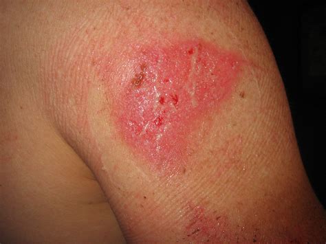 how to treat road rash 2