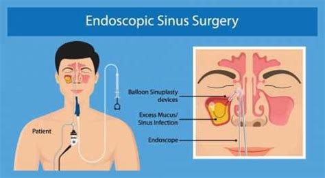 Endoscopic Sinus Surgery Philadelphia | BergerHenry ENT