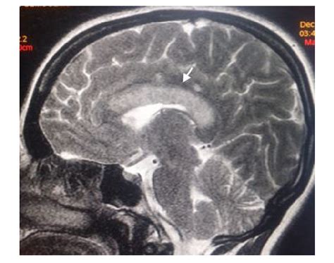 T2 Flair Magnetic Resonance Imaging Of The Brain Showing Hyperintensity