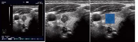 Labeled Thyroid Ultrasound