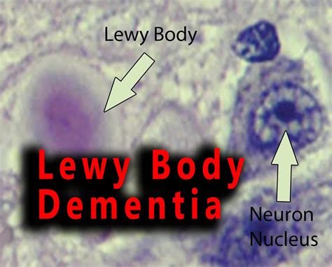 Lewy Body Dementia - Costamedic