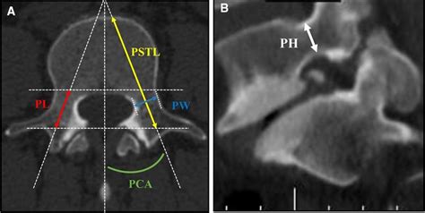 Diagram And Axial Ct Scan At The Mid Pedicle Cut Showing Measurement Of