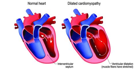 Doberman Pinscher Dilated Cardiomyopathy Dcm Simplified Doberman Planet