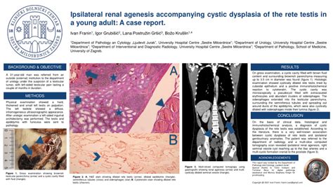 Pdf Ipsilateral Renal Agenesis Accompanying Cystic Dysplasia Of The