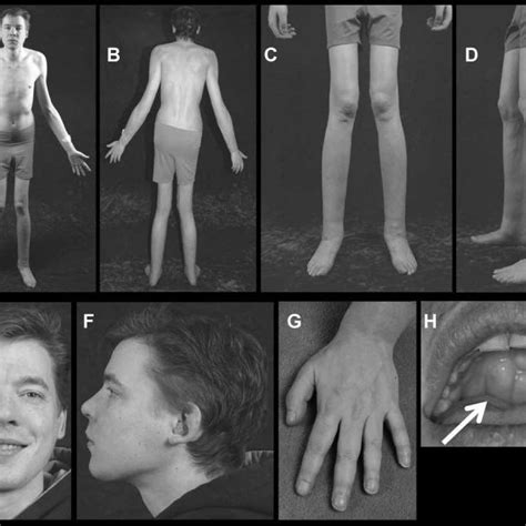 Pdf Camurati Engelmann Disease Unique Variant Featuring A Novel