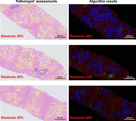 A Comparison Between Pathologists Assessments And The Shg Algorithm